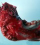 Mutation Found in Jaw Tumor: World's First