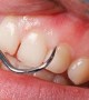 Perio Bacteria Found to Spur Cancer Growth in Mouth, Say Researchers