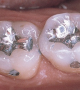 New Easier to Harden Dental Filling Material Makes Dental Treatment Faster and Easier